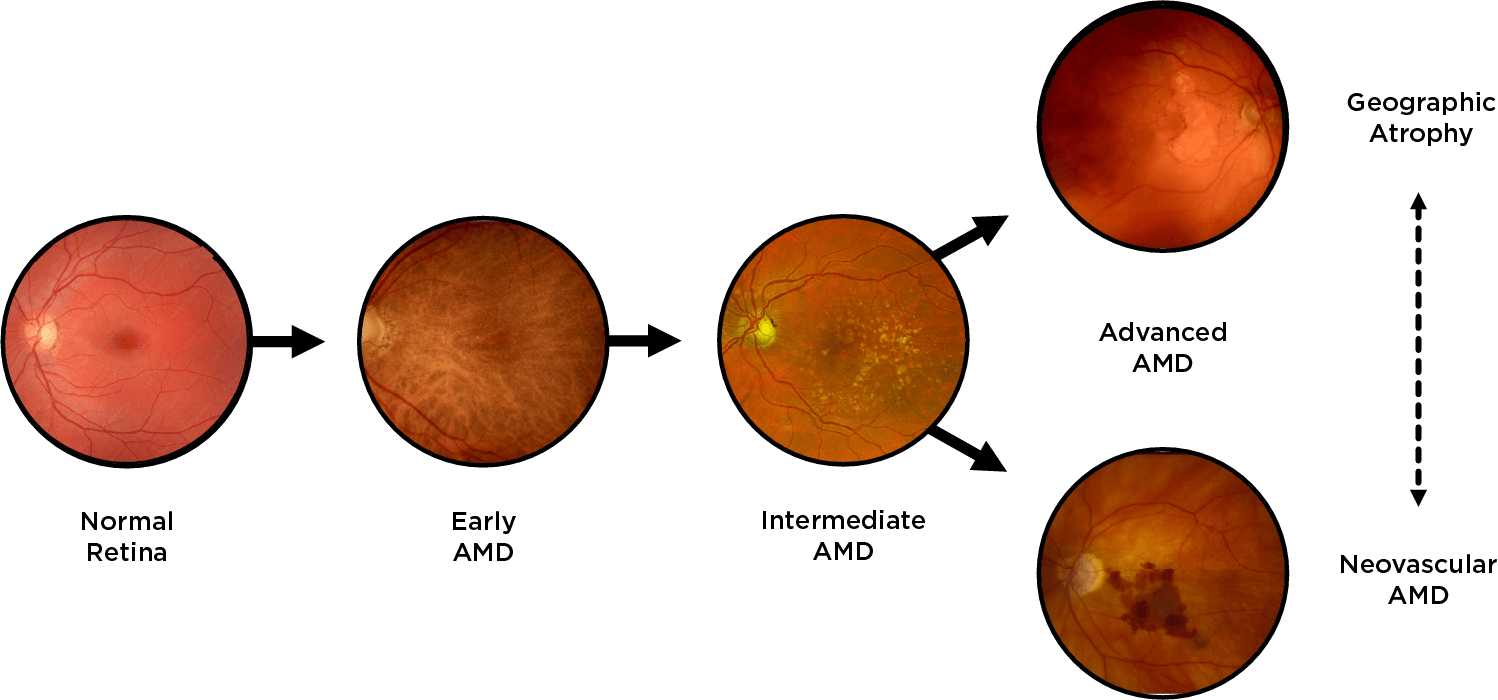 Flow chart of progression of a age-related macular degeneration to both GA and neovascular AMD