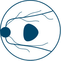 a diagram showing geographic atrophy with a unifocal lesion