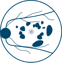 a diagram showing geographic atrophy with a multifocal lesion