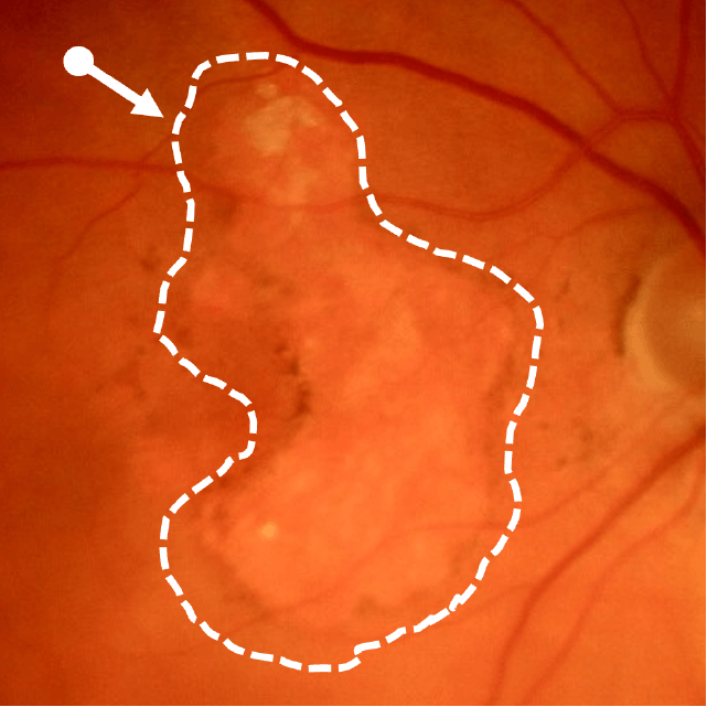 Color fundus photo (CFP) image of large geographic atrophic lesion