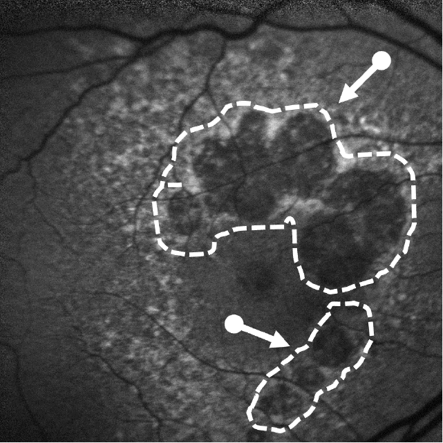 Fundus autofluorescence (FAF) of advanced AMD (GA) with multiple atrophic lesions