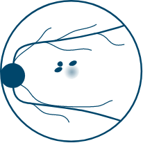 a diagram showing geographic atrophy with small lesions