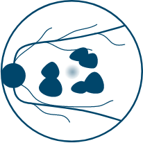 a diagram showing geographic atrophy with large lesions