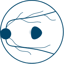 a diagram showing geographic atrophy with a foveal lesion