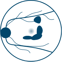 a diagram showing geographic atrophy with a non-foveal lesion