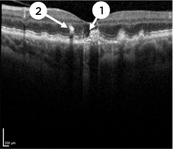 Optical coherence tomography (OCT) of Intermediate AMD